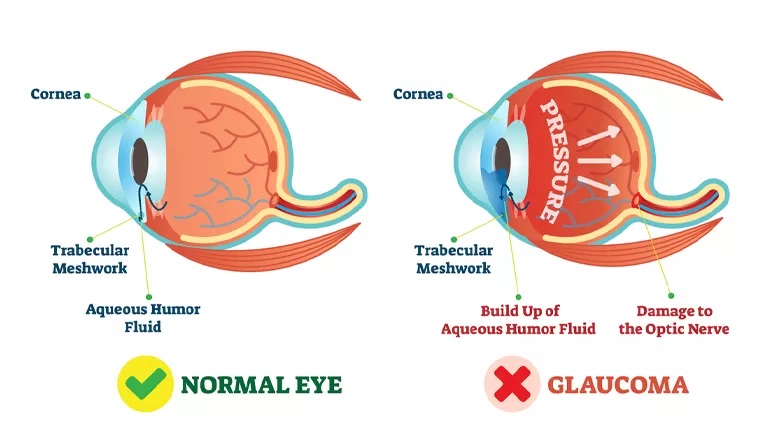 Normal Eye Vs Glaucoma