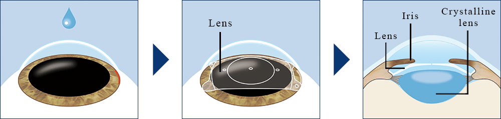 ICL and IPCL Eye lens at Laxmi Eye Institute and Hospitals located in Navi Mumbai centers in Panvel, Kharghar, Dombivali, and Kamothe