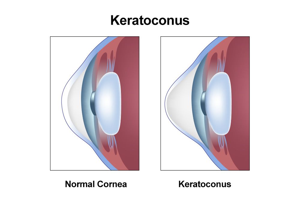 Keratoconus Treatment at Laxmi Eye Institute, in Navi Mumbai, Panvel, kharghar, Dombivali and Kamothe.