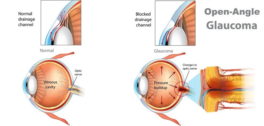 Open angle glaucoma at Laxmi Eye Hospitals and Institute in Navi Mumbai, centres at Panvel, Kharghar, Kamothe and Dombivali.