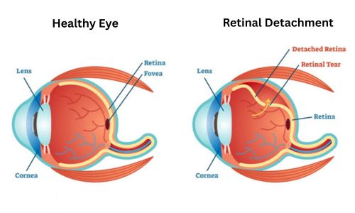 Retinal Detachment at Laxmi Eye Hospital, in Navi Mumbai, Panvel, kharghar, Dombivali and Kamothe.
