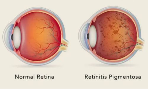 Retinitis Pigmentosa at Laxmi Eye Hospital, in Navi Mumbai, Panvel, kharghar, Dombivali and Kamothe.