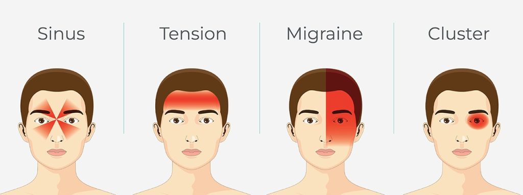 Types of Headaches Behind the Eyes