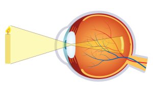 What are the causes of Hyperopia?