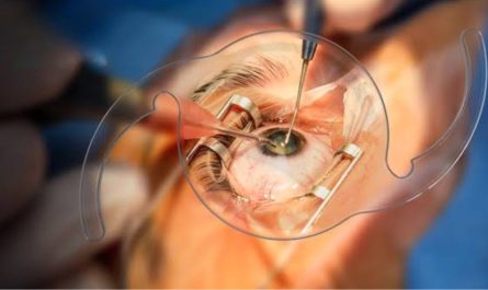 Delayed Cataract Surgery Risks