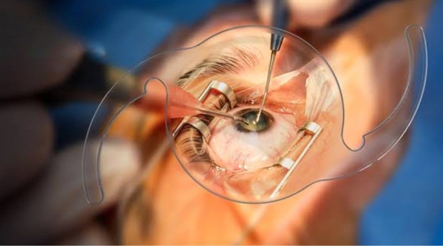 Why You Shouldn’t Delay Cataract Surgery: Understanding the Risks