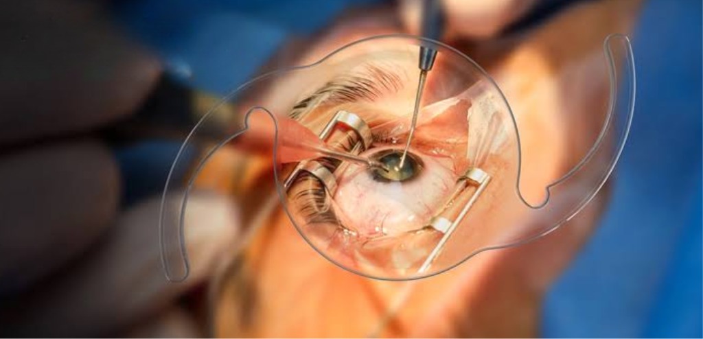 Delayed Cataract Surgery Risks