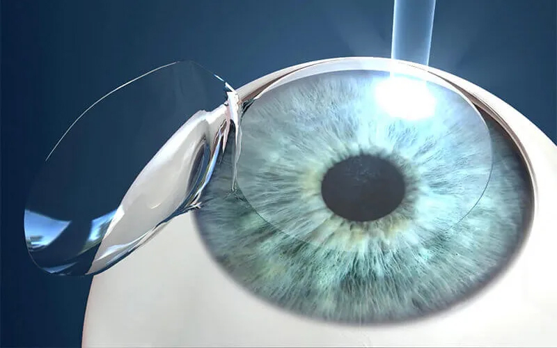 LASIK (Laser-Assisted In Situ Keratomileusis)