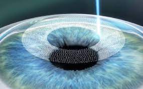 Femto LASIK (Femtosecond Laser-Assisted In Situ Keratomileusis):