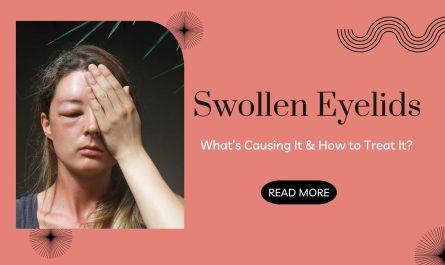 Swollen Eyelids What’s Causing It and How to Treat It