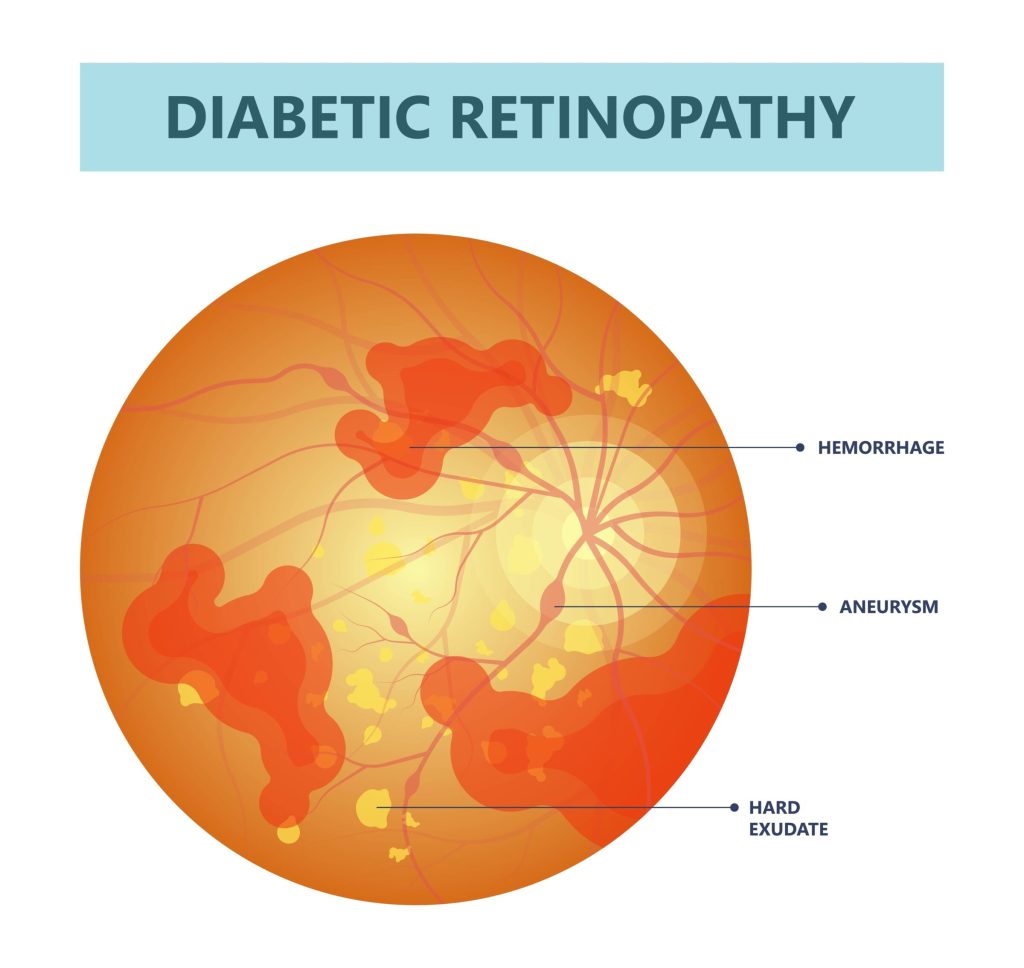 Diabetic Retinopathy