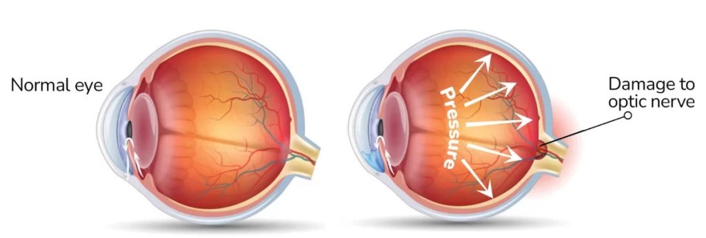 What is Glaucoma?