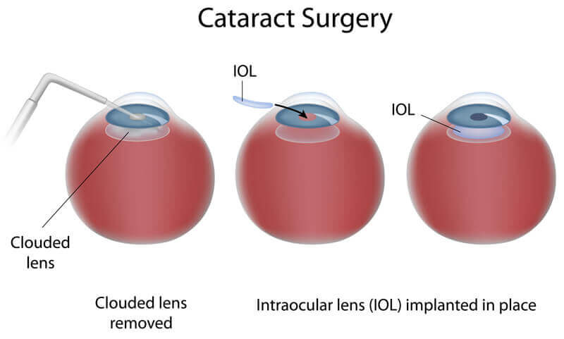 Understanding Cataract Surgery