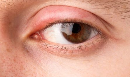 Swollen Eyelids: What’s Causing It and How to Treat It?