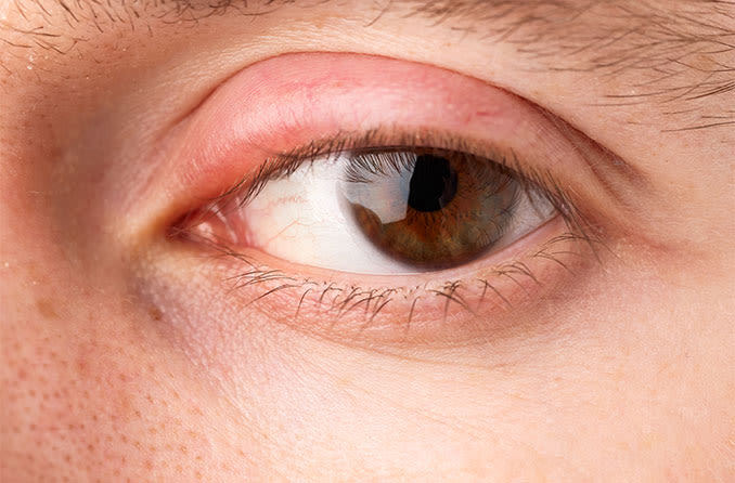 Swollen Eyelids: What’s Causing It and How to Treat It?