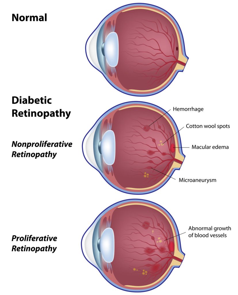 Understanding Diabetic Retinopathy