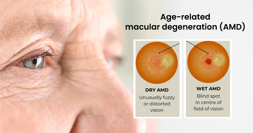 age-related macular degeneration (AMD)