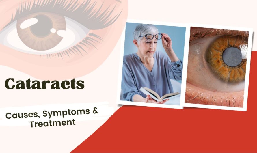 Everything You Need to Know About Cataracts: Causes, Symptoms & Treatment