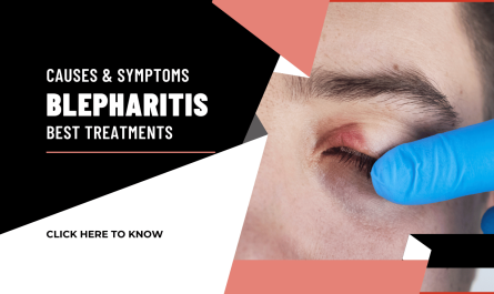 Blepharitis: Causes, Symptoms & Best Treatments