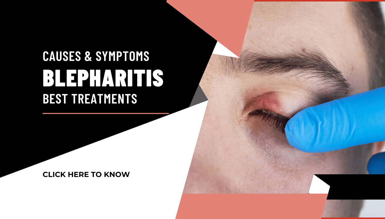 Blepharitis: Causes, Symptoms & Best Treatments