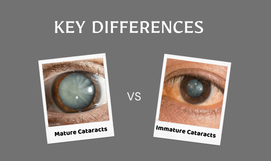 Mature vs. Immature Cataracts: Key Differences