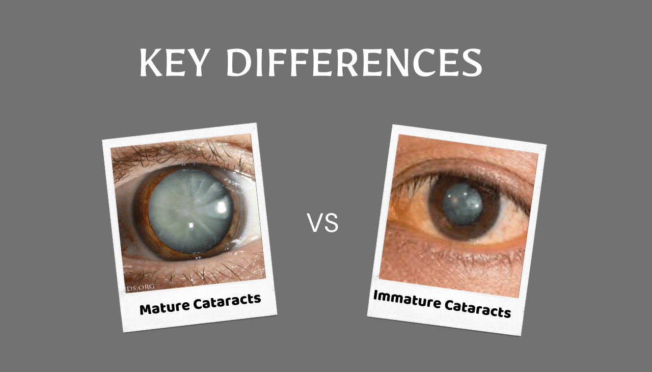 Mature vs. Immature Cataracts: Key Differences