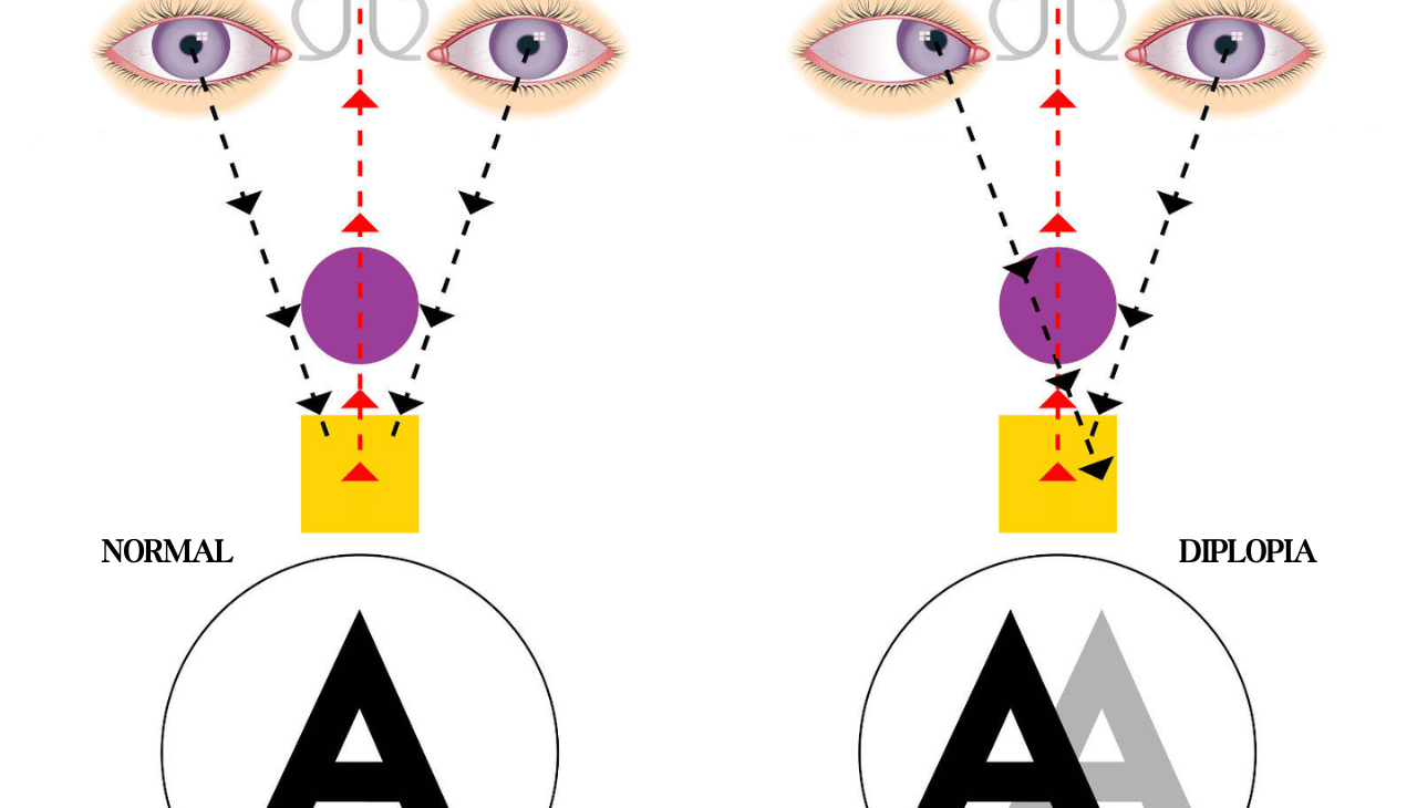 Diplopia