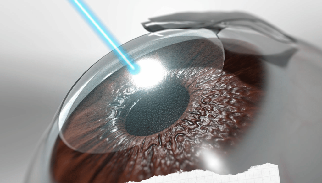 Understanding LASIK Surgery