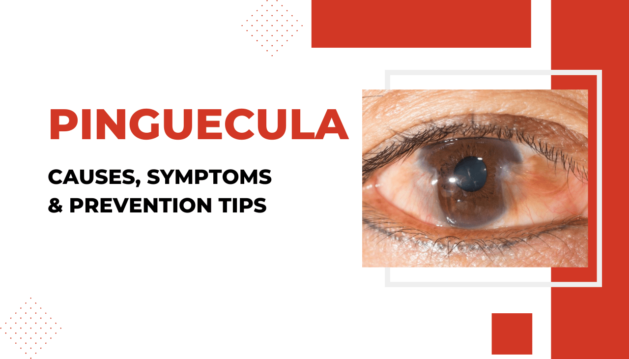 Pinguecula: Causes, Symptoms & Prevention Tips