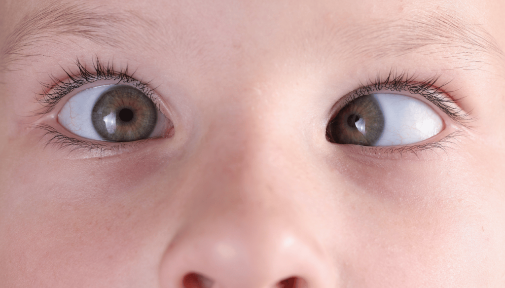 Causes and Symptoms of Squint Eye