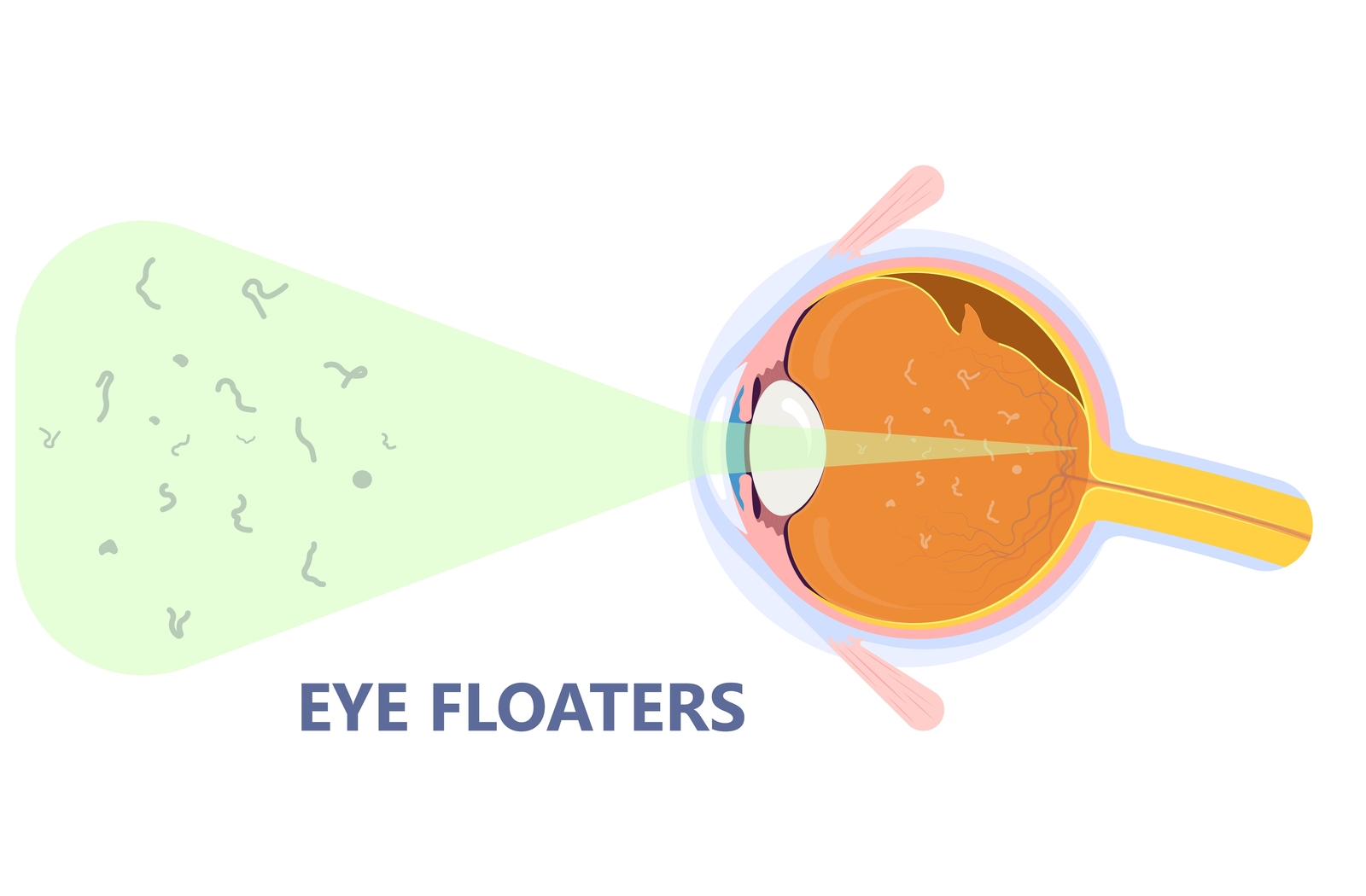 Eye Floaters