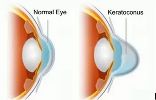 Keratoconus Treatment at Laxmi Eye Hospitals and Institute in Navi Mumbai, best eye care centres at Panvel, Kharghar, Kamothe and Dombivali.